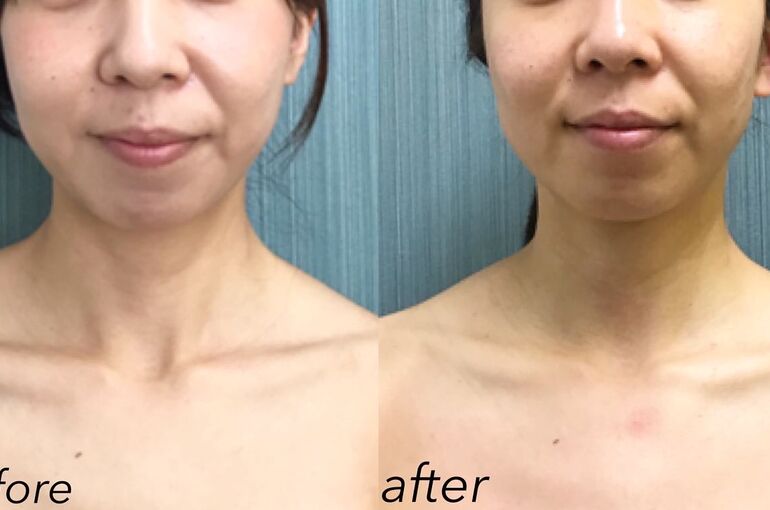 三原市で小顔 年齢肌やシワ たるみ 法令線 二重顎でお悩みの方はハイフをお試しください 尾道で高い技術力を持つエステ サロンをお探しならぜひご利用ください