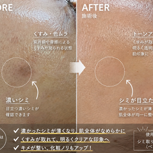 広島初「針を使わない脂肪溶解💉」シーボレス | 三原、尾道エリアで